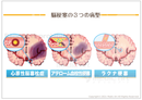 脳梗塞の３つの病型 ［シート］
