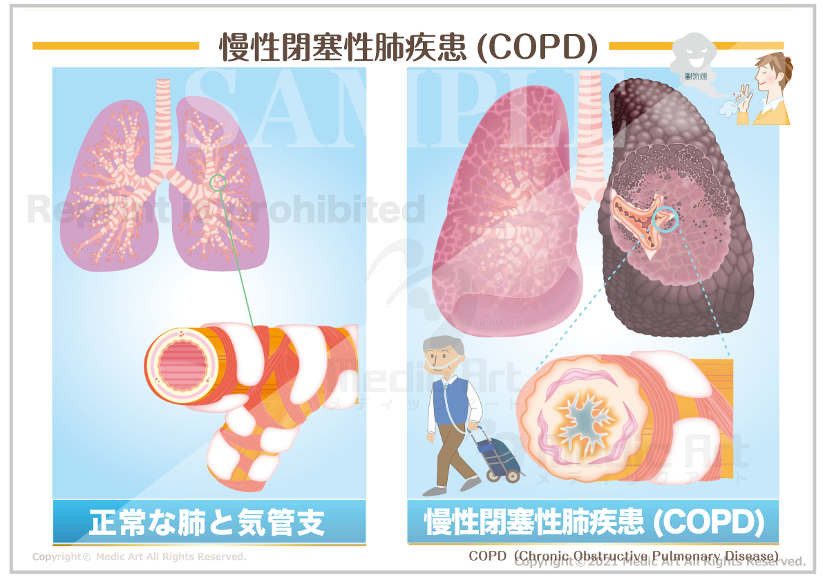 慢性閉塞性肺疾患（COPD：chronic obstructive pulmonary disease)［シート］
