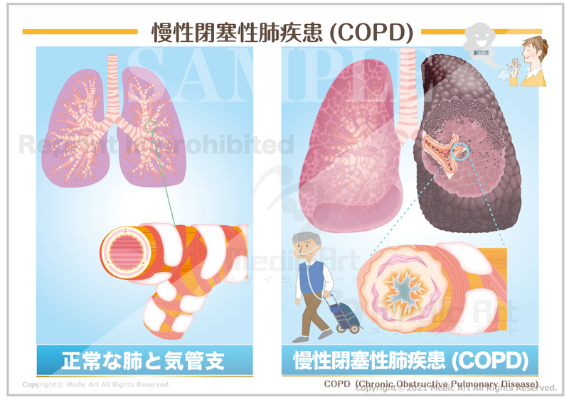 慢性閉塞性肺疾患（COPD：chronic obstructive pulmonary disease)［シート］