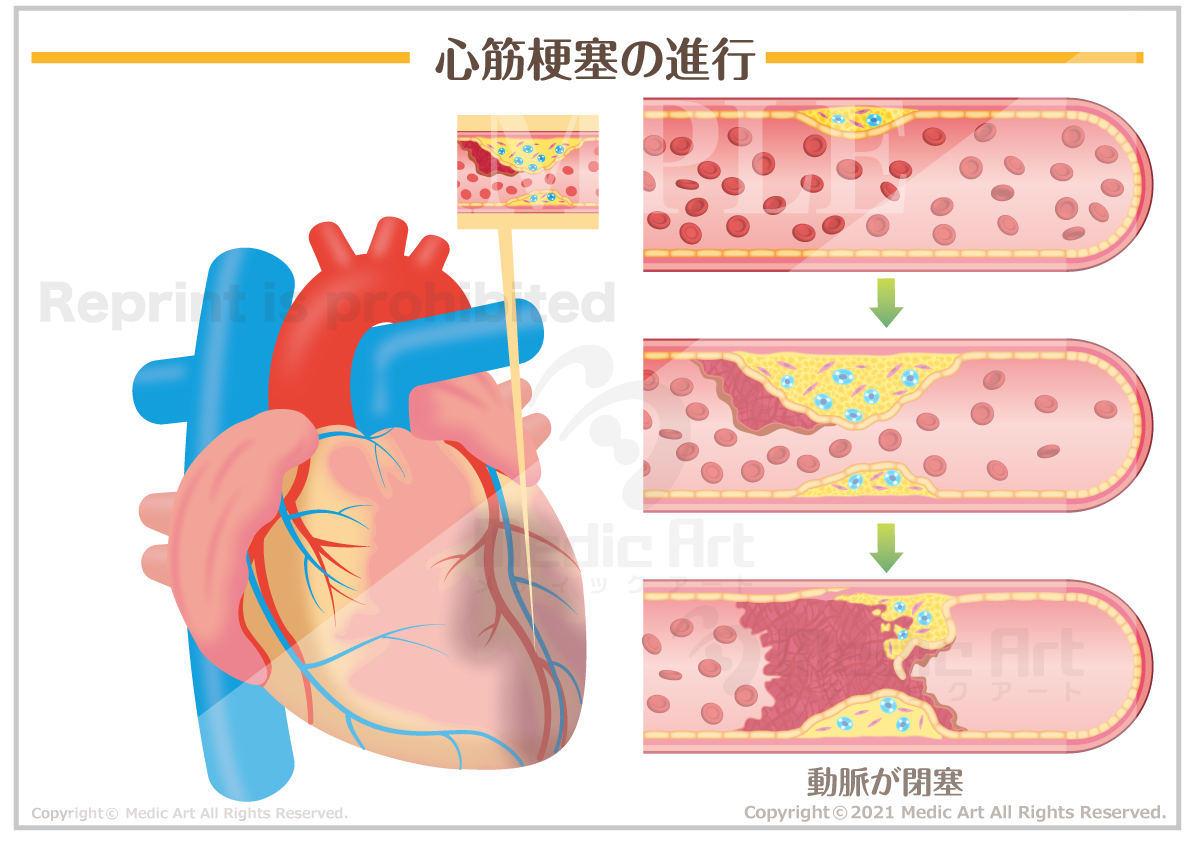 心筋梗塞のイメージ［シート］