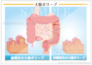 大腸ポリープ［シート］