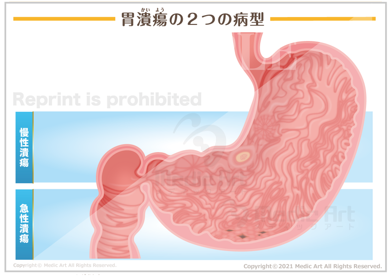 胃潰瘍（いかいよう）の２つの病型［シート］