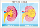 腎がんの２つの病型［シート］