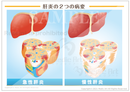 肝炎の２つの病型 ［シート］