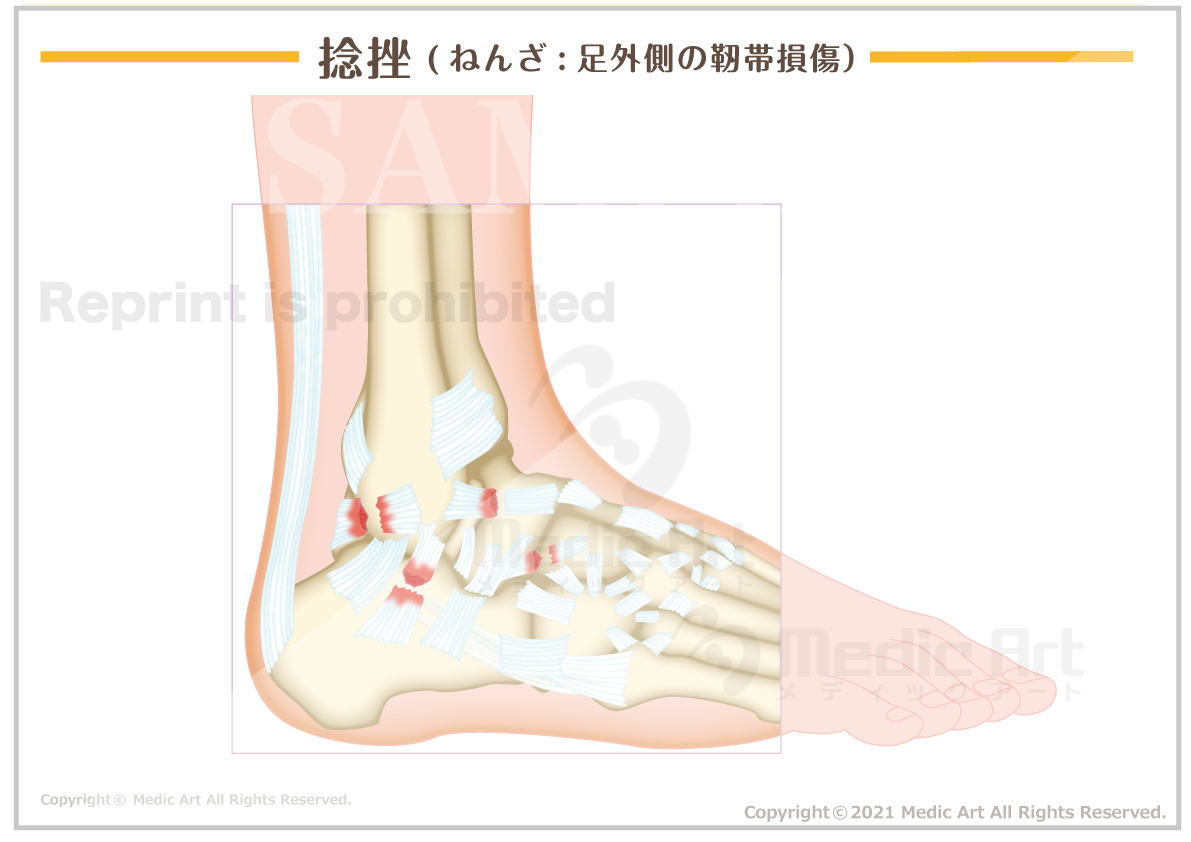 捻挫(ねんざ:足外側の靭帯損傷)［シート］
