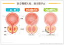 前立腺肥大症と前立腺がん［シート］