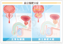 正常な前立腺と前立腺肥大症［シート］