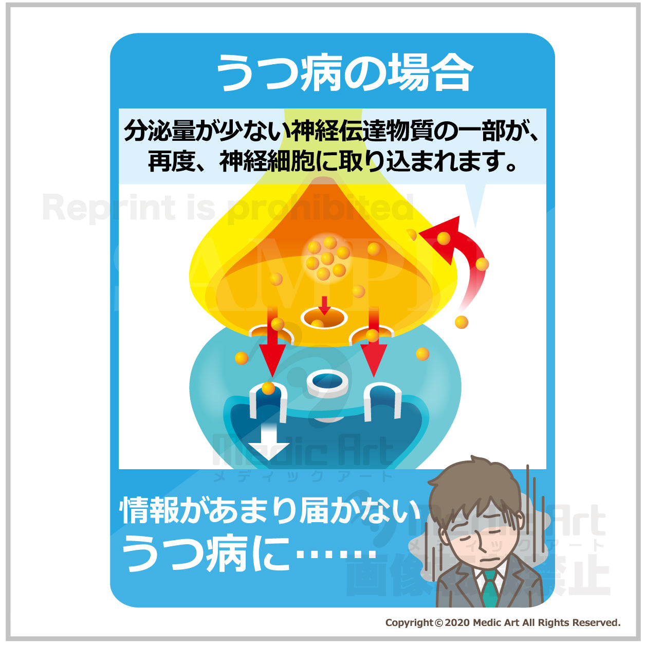うつ病になったときの脳内の様子：抗うつ薬（SSRI：セロトニン再取り込み阻害薬)が効くしくみ2