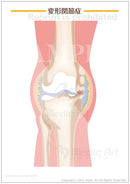 【骨・関節の病気】変形性関節症 ［シート］