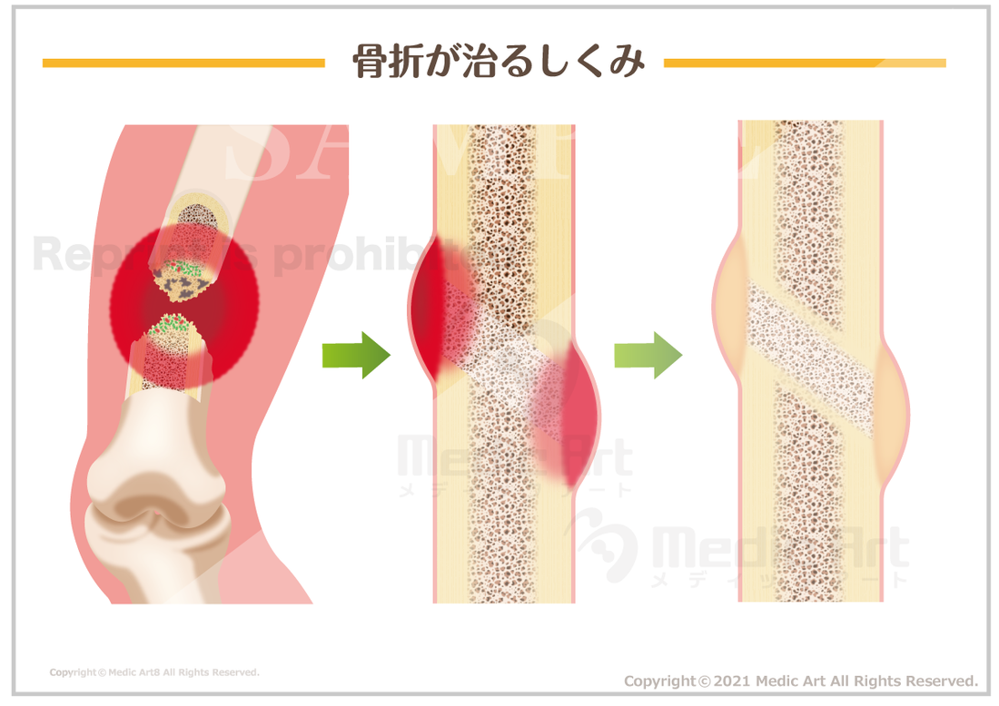 外傷】骨折が治るしくみ ［シート］