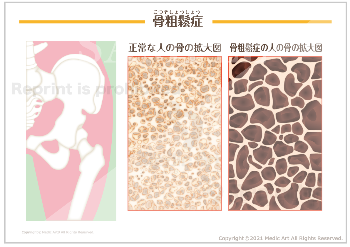 【骨・関節の病気】骨粗鬆症(こつそしょうしょう) ［シート］