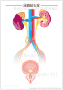 尿路結石症［シート］