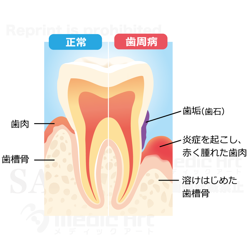 正常な歯と歯周病の歯 の比較［文字付］